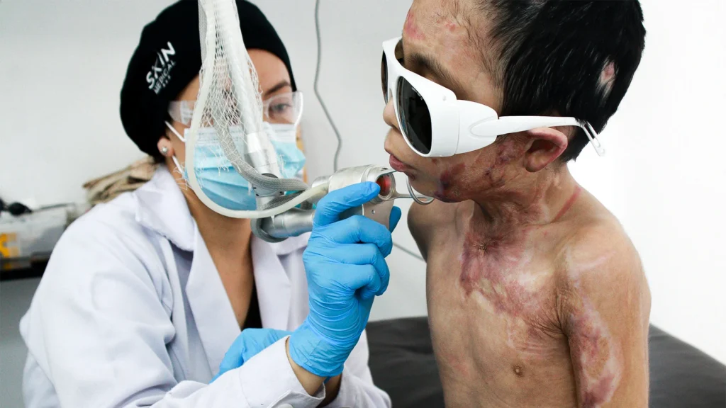 Niño con quemaduras graves . Tratamiento regenerativo quemaduras RegenerisLaser Lima