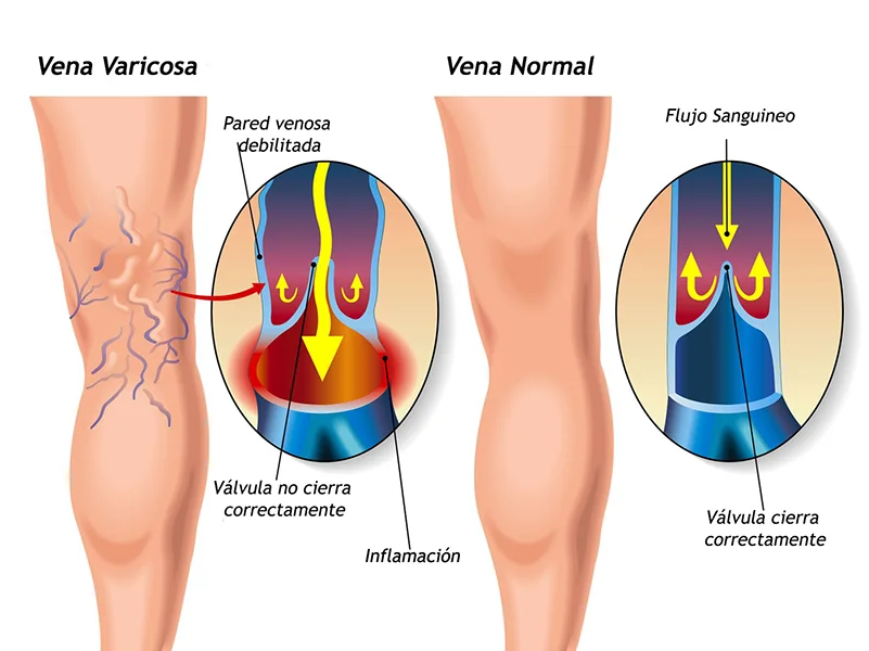 Vena varicosa con válvulas dañadas y flujo inverso versus vena normal con válvulas funcionales y flujo correcto.