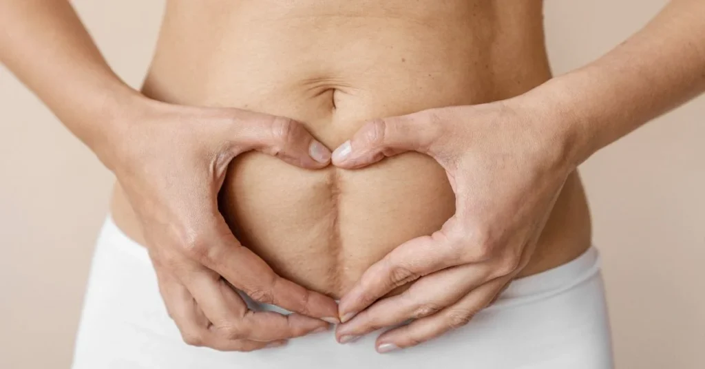 Cicatriz abdominal vertical postquirúrgica en mujer
