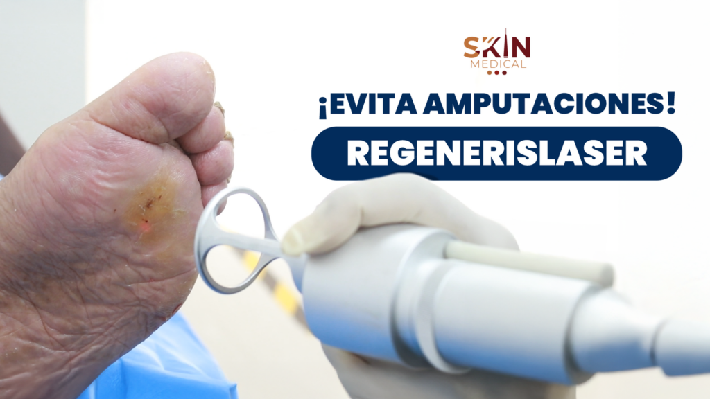 Primer plano de la planta de un pie con lesión en el talón mientras un médico con guante sostiene un dispositivo de láser