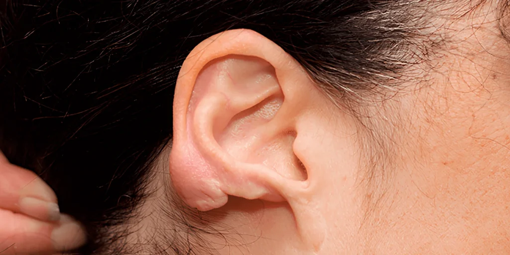 Los mejores especialistas en queloides en la oreja en lima